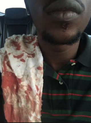 Dammy Krane with blood stains on shirt from Bottle fight