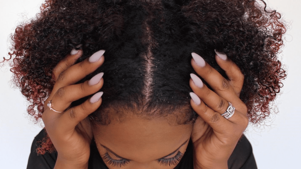 5 Common Symptoms Of Dandruff | Novice2STAR